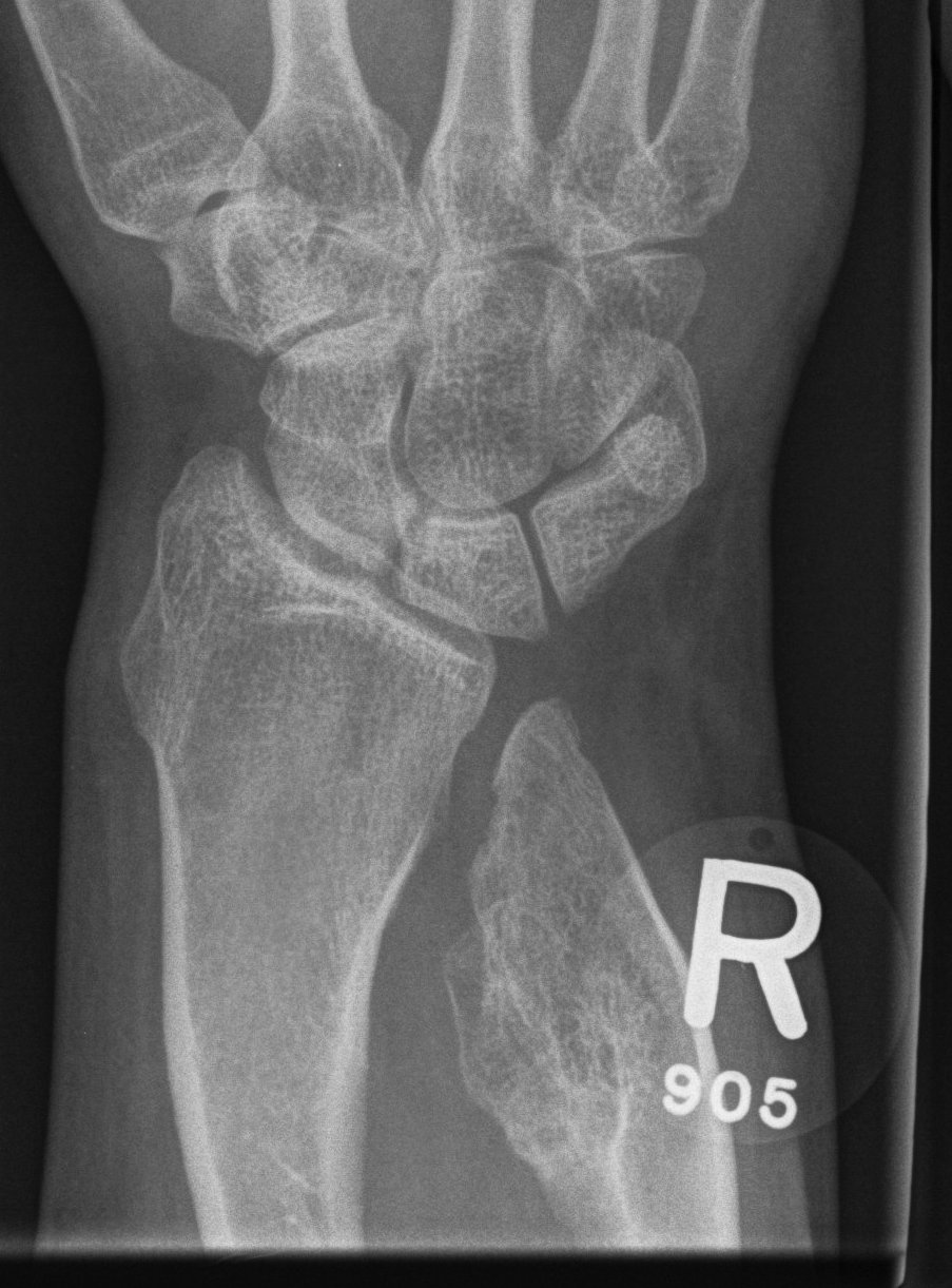 Osteochondromas Wrist